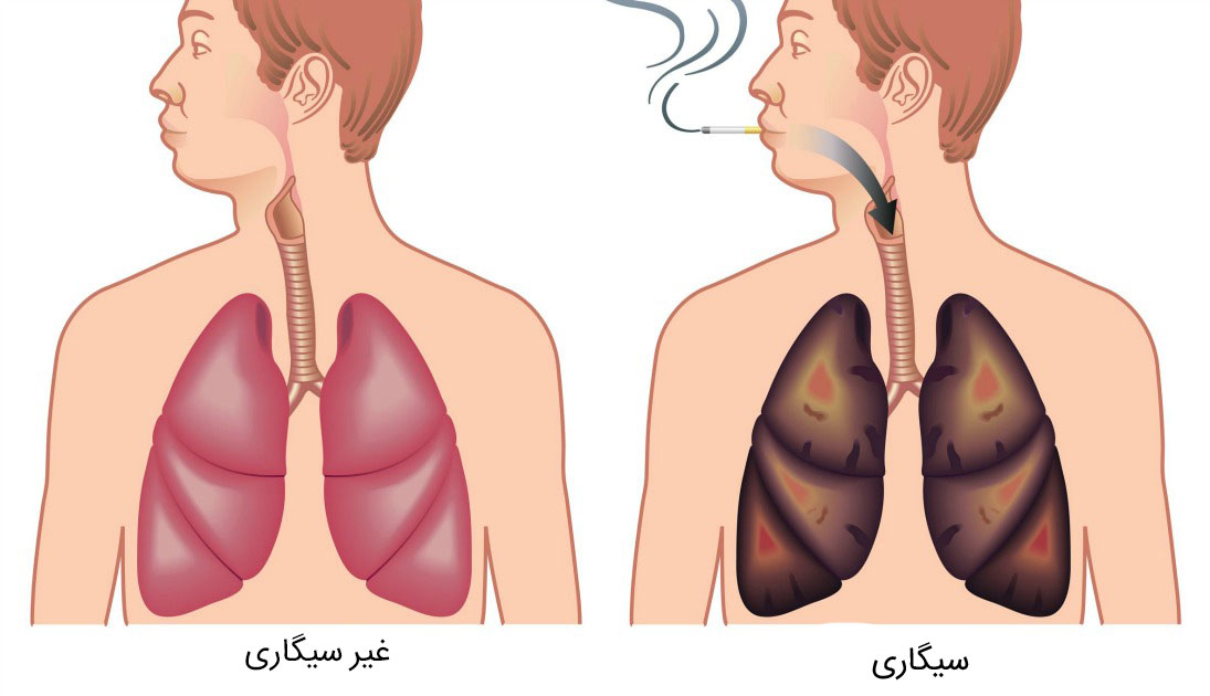ریه افراد سیگاری